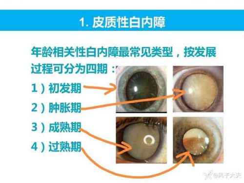 白内障手术不做可能会引起这些风险j9国际站登录重庆做白内障手术